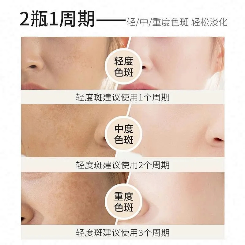 OEM ODM Beauty Anti Freckle Treatment Removal Cream Freckle Whitening Cream