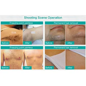 Skin clinic Painless and permanent hair removal 808nm diode laser hair removal machine