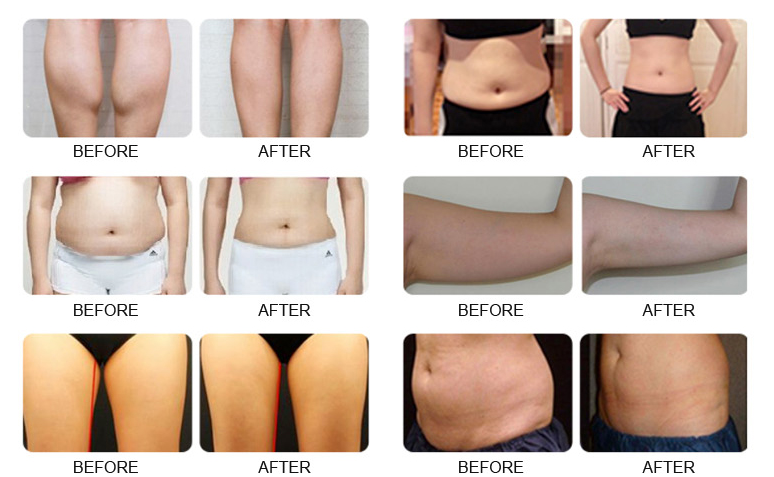 body shaping velashape machine price