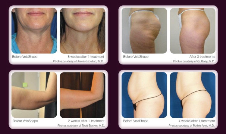 body shaping velashape machine price