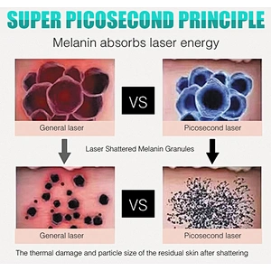 C 1064nm 532nm 755nm picosecond laser machine for tattoo removal