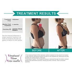 Portable lipo slimming machine liposonix for body shape weight loss