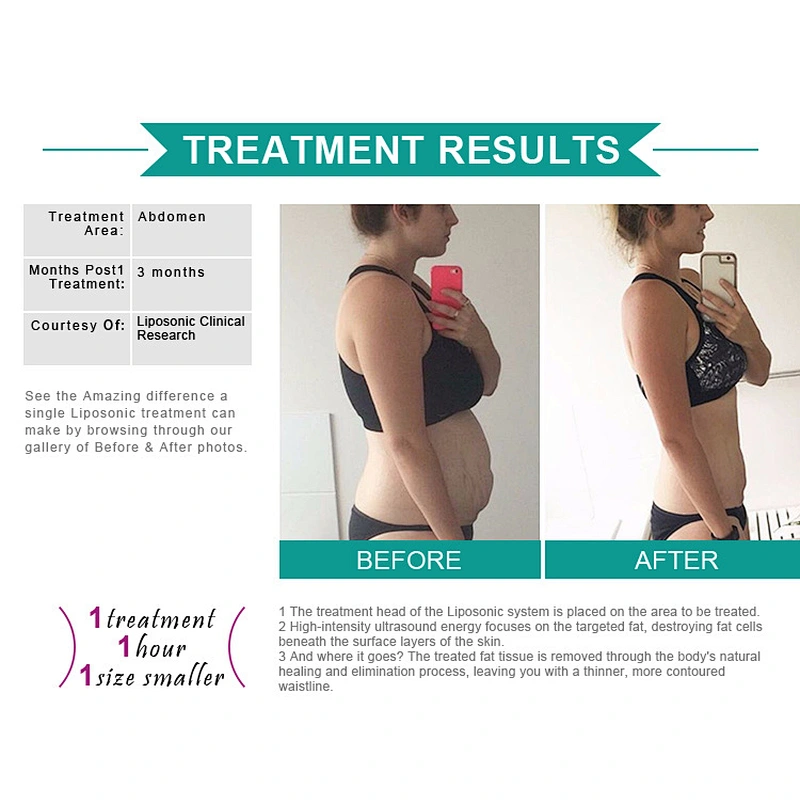 Portable lipo slimming machine liposonix for body shape weight loss