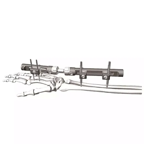 Distal Radius External Fixation