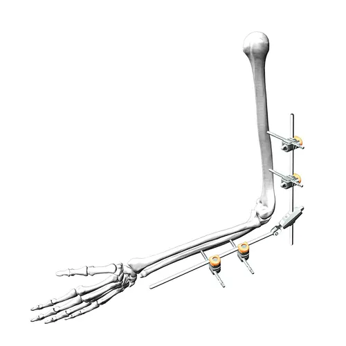 Children's Elbow External Fixation