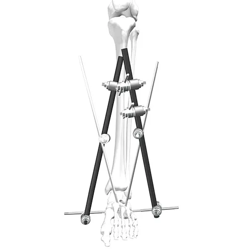 External Fixation