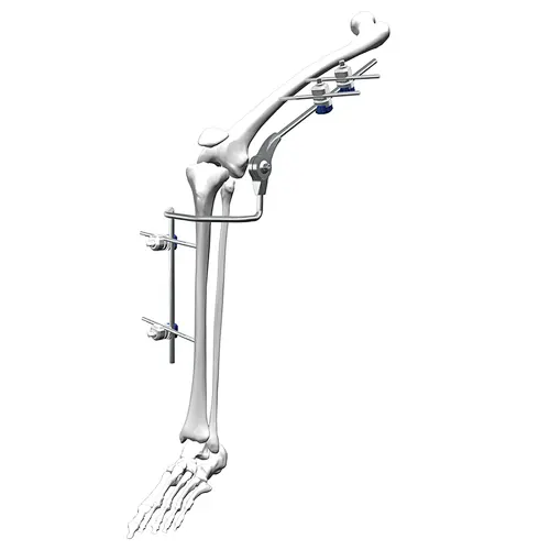 External Fixation