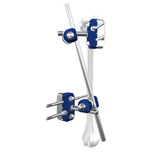 Humerus External Fixation