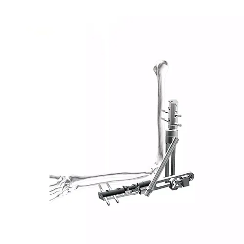 Elbow External Fixation