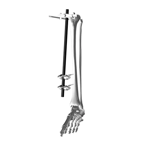 Tibial Plateau External Fixation