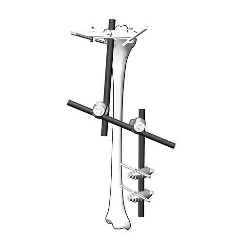 Tibia External Fixation