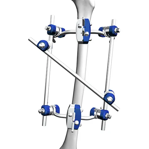 External Fixation