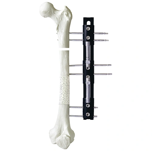 LRS External Fixation
