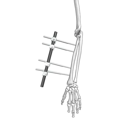 Φ11 Radius External Fixation