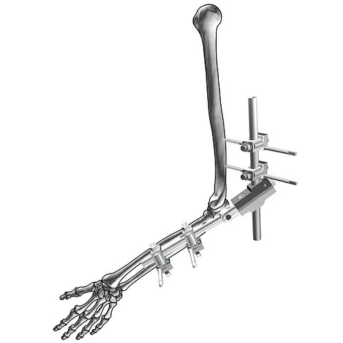 Elbow External Fixation