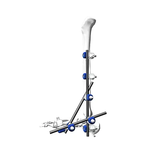 Ankle Stable Frame External Fixation