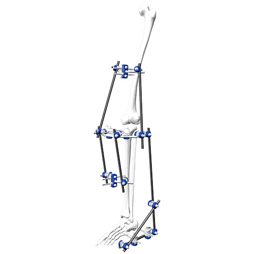 Frame External Fixation