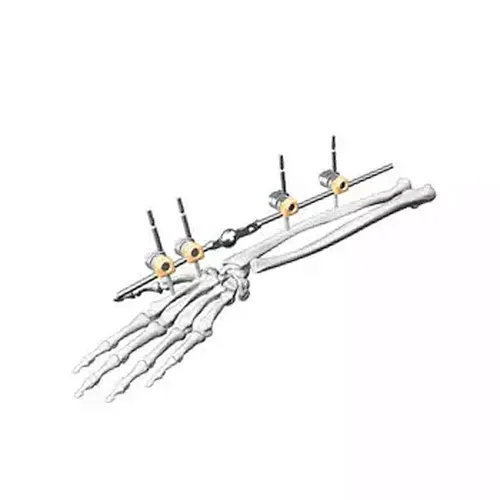 Children's Wrist External Fixation