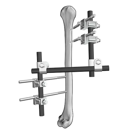 Humerus External Fixation