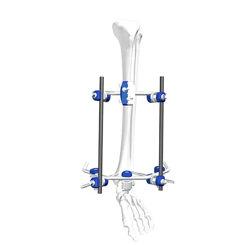 Tibia External Fixation