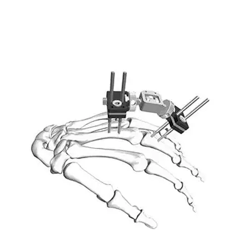 Finger External Fixation