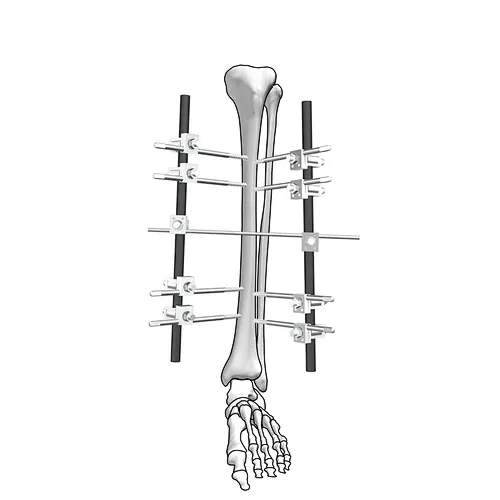 Φ11 Dissection II Tibia External Fixation