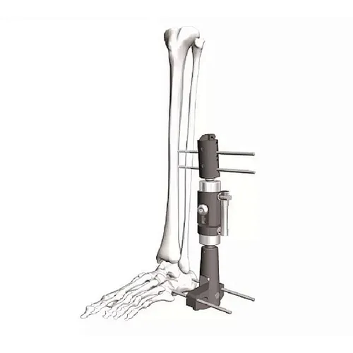Ankle External Fixation