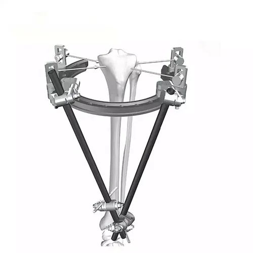 Tibia External Fixation