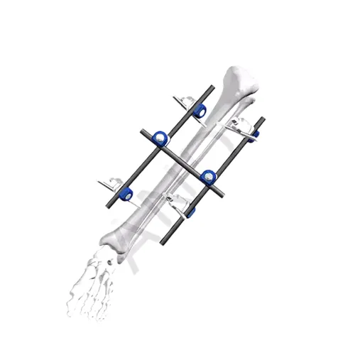 External Fixation