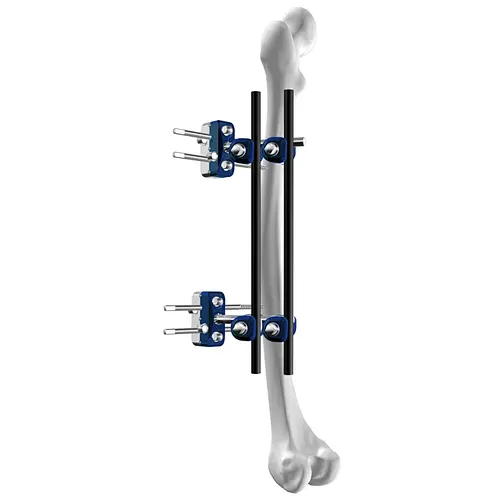 Femur External Fixation