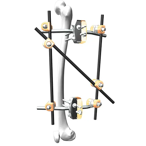 Femur External Fixation