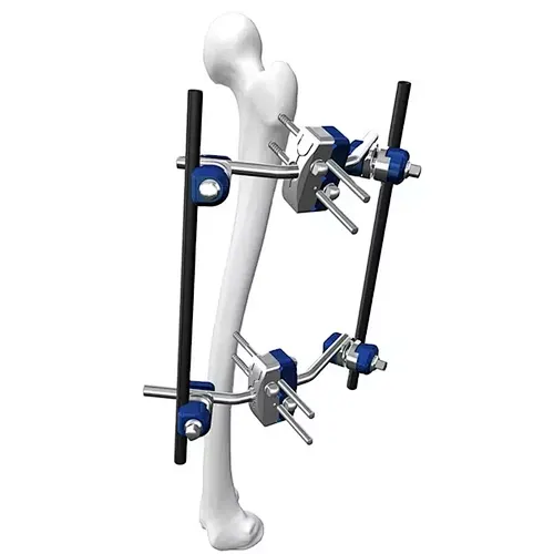 External Fixation