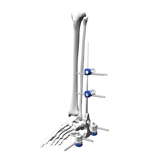External Fixation