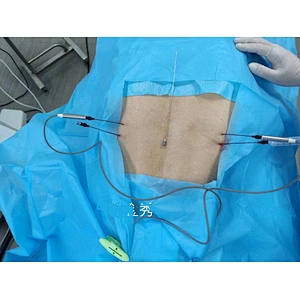 Radiofrequency Thermo lesion Generator for pain management
