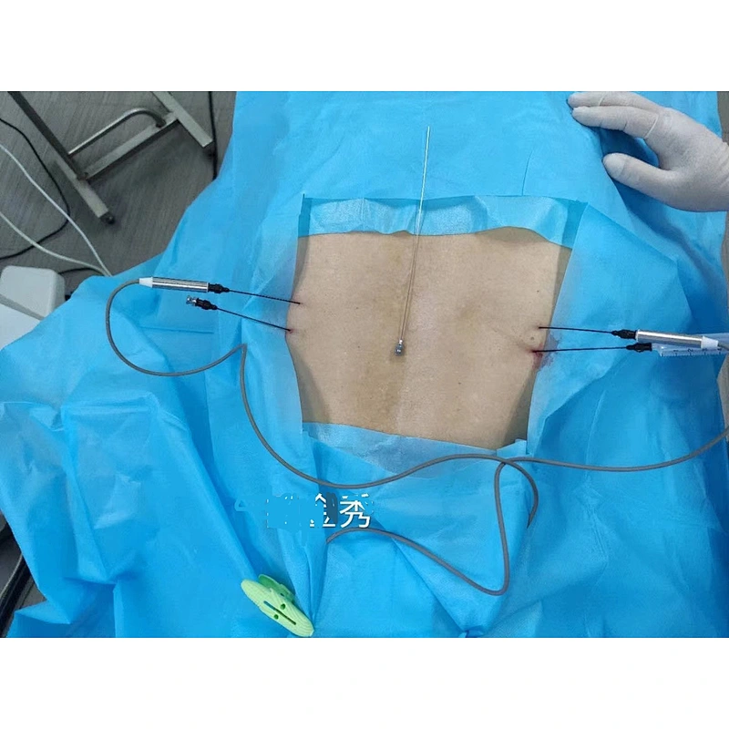 Disposable Unified RF cannula (hybrid rf needle) straight tip