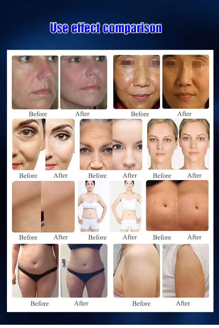 <h3 class="features--headline">Features and benefits</h3> Safe And Effective - Non-Invasive, Non-Surgical Treatment Long-Lasting Results 22d Hifu Treatment - Improve Skin Laxity Wrinkles, Body Tightening, Facial Lifting 22d Ultrasound Hifu - Microfocus And Macrofocus Ultrasonic Technology 2d Hifu Benefits - Stimulation Of Collagen Generation, Tightening Of Sagging Skin <hr /> <h5></h5> <h5><span class="tw-text-2xl tw-font-bold" style="color: #99ccff;">IN STOCK READY TO SHIP</span></h5> <h5><span class="tw-text-2xl tw-font-bold" style="color: #99ccff;">1 YEAR WARRANTY + 3 YEAR TECH SUPPORT</span></h5> <h5><span class="tw-text-2xl tw-font-bold" style="color: #99ccff;">30 DAY MONEY-BACK AND <a href="https://salonmachines.com/refund_returns/">RETURN POLICY</a></span></h5> <h5><span class="tw-text-2xl tw-font-bold" style="color: #99ccff;">FREE WORLDWIDE SHIPPING <a href="https://salonmachines.com/shipping-policy/">SHIPPING POLICY</a> </span></h5> <h5><span class="tw-text-2xl tw-font-bold" style="color: #99ccff;">PROFESSIONAL BEAUTY <a href="https://salonmachines.com/">SALON MACHINES</a> EQUIPMENT</span></h5> &nbsp; <div class="product-block product-block--sales-point"></div> 22d Max Hifu Machine RF Lipo Hifu 2 In 1