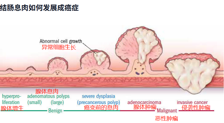 adenoma recurrence