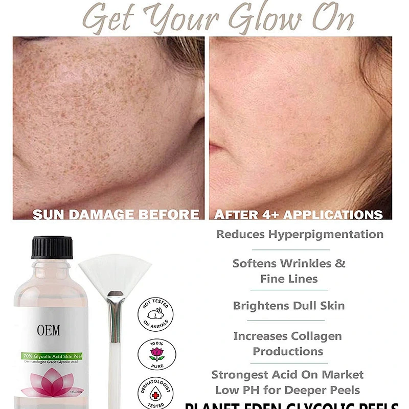 70% Glycolic Acid Chemical Skin Peel Kit