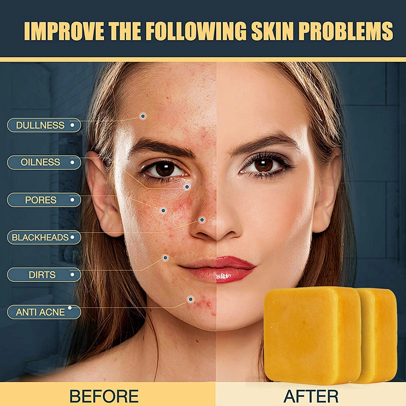 Organic Natural Toilet Whitening Savon Tumeric Face Kojic Acid Ginger Soap Anti Acne Handmade Turmeric Soap