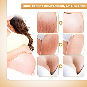 Skin Care Private Label Mango Pregnancy Stretch Mark Scars Removal Cream Anti Creme Pour Vergeture