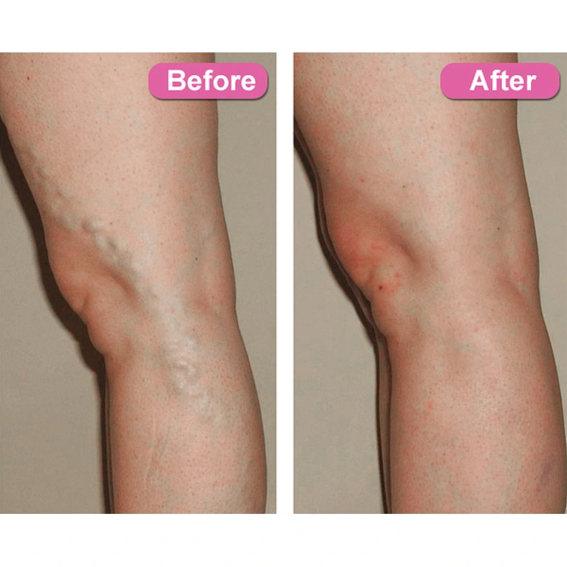 Germany Leg Vein Varicose Removal Treatment EVLT 980nm 1470nm Diode Laser For Vein Care equipment