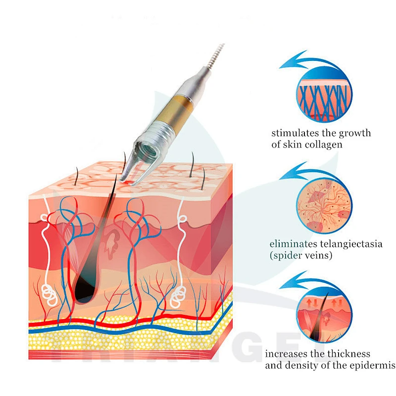 30w/60w Portable Spider Vein removal machine / Vascular Removal 980nm  diode laser 980 nm machine