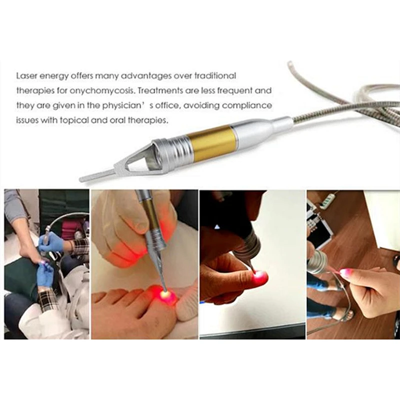 980nm laser nail fungus removal laser toe nail fungus laser podiatry