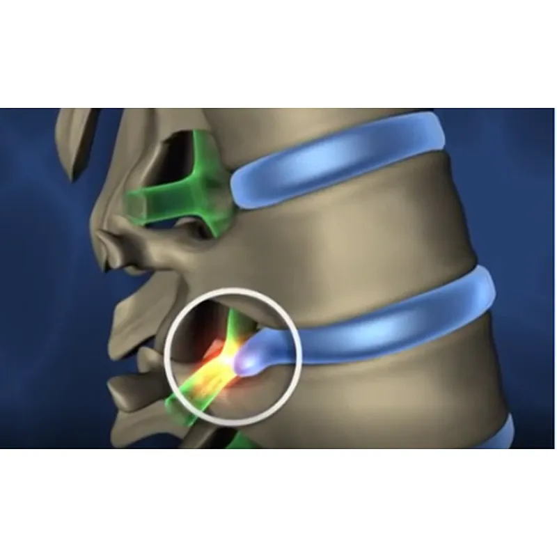 PLDD treatment laser surgery 1470 laser pldd
