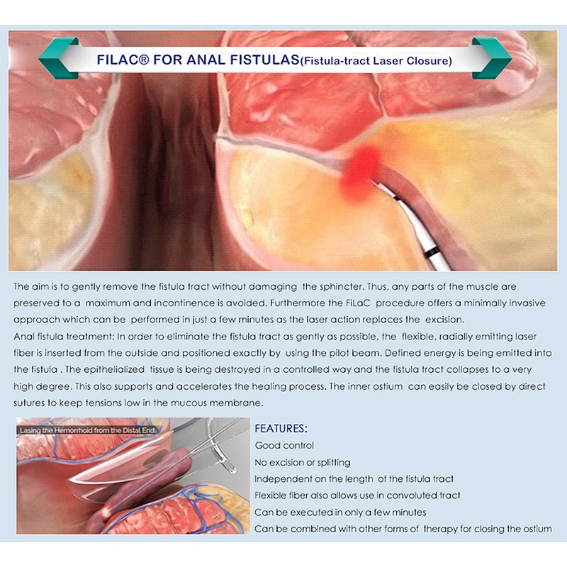 Anal fistula hemorrhoids diode laser  hemorrhoidectomy device diode laser surgery hemorrhoids 980nm laser