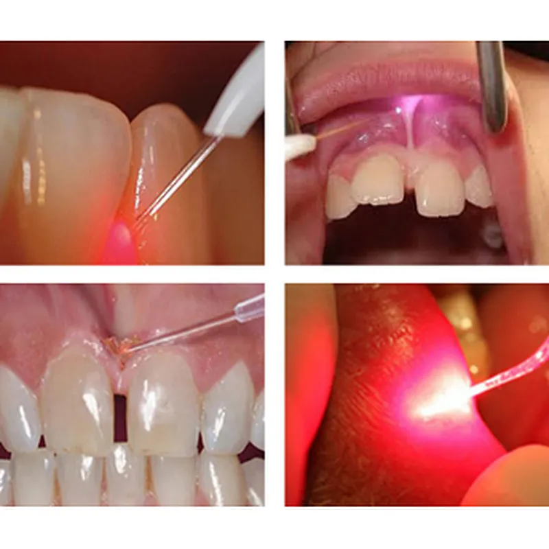 Hot Sale dental low level dental laser 980nm 30w dental teeth whitening machine price dental soft tissue Laser