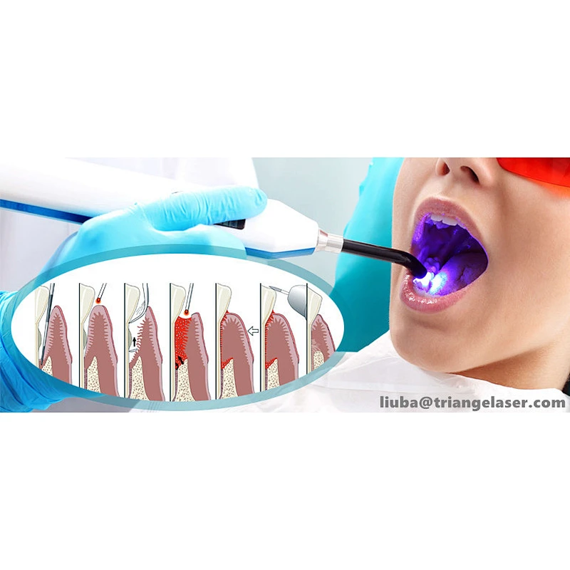 2024 Dental Laser 980nm diode laser soft tissue cutting laser CE Marked
