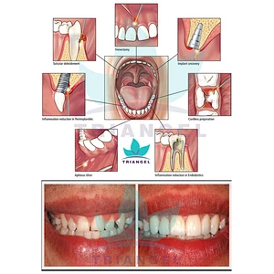 Hot Sale dental low level dental laser 980nm 30w dental teeth whitening machine price dental soft tissue Laser