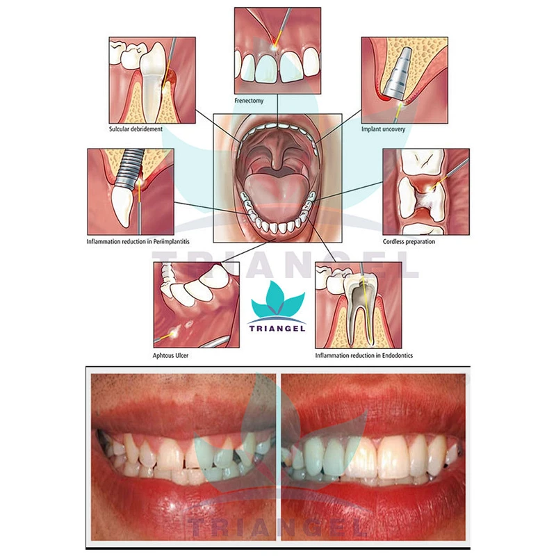 Hot Sale dental low level dental laser 980nm 30w dental teeth whitening machine price dental soft tissue Laser