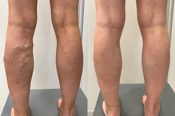 varicose romoval